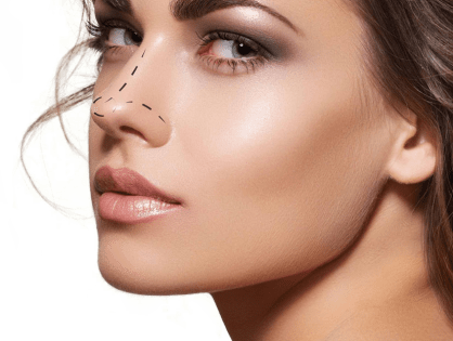 Rinoplastia