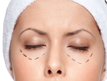 Blefaroplastia