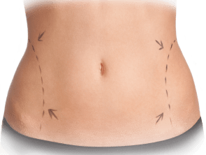 Lipoabdominoplastia
