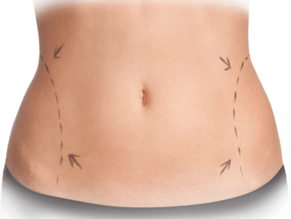 Lipoabdominoplastia