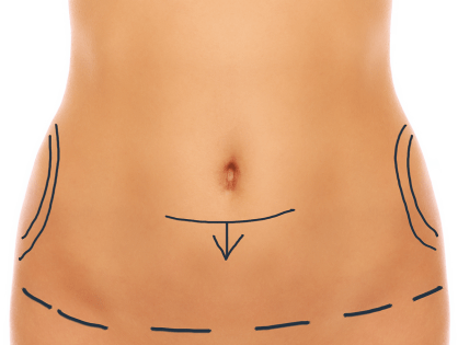 Lipoabdominoplastia y obesidad